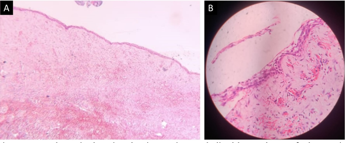 H and E-stained section showing cystic capsule lined by 2-4 layers of odontogenic epithelium in A) Original magnification x40, and B) Original magnification x400.