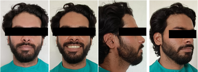 Pre treatment extraoral photos