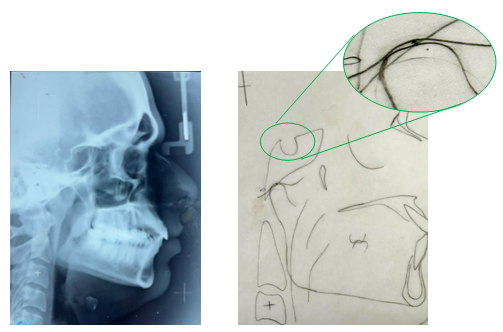 Pre treatment lateral cephalogram