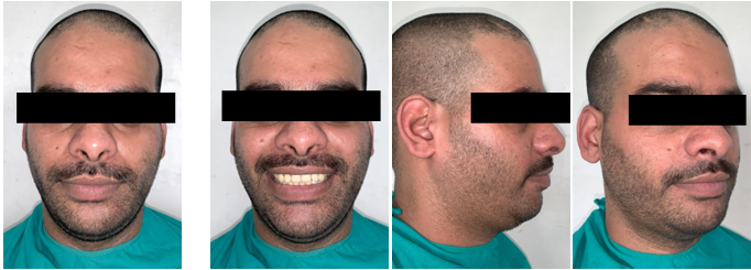 Mid treatment extraoral photos after 6 months of splint therapy