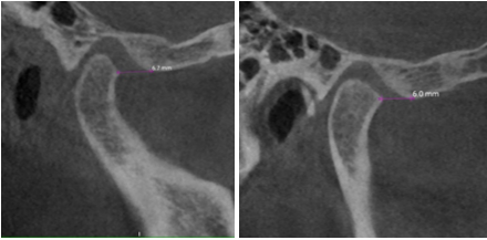 Mid treatment CBCT scan after 6 months of splint therapy