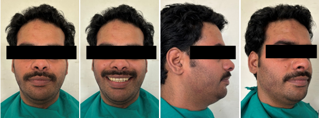 Current treatment extraoral photos