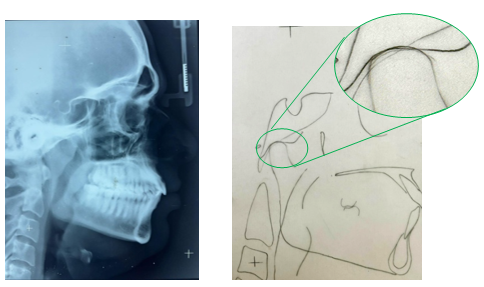 Current treatment lateral cephalogram