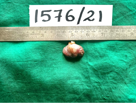 Gross outer surface of myxoma smooth and glistening