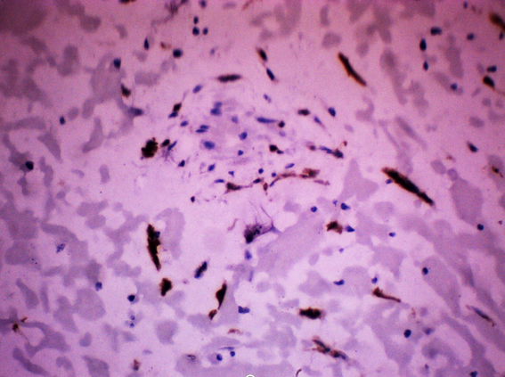 IHC Calretinin showing positive stain in stellate cells (HP)