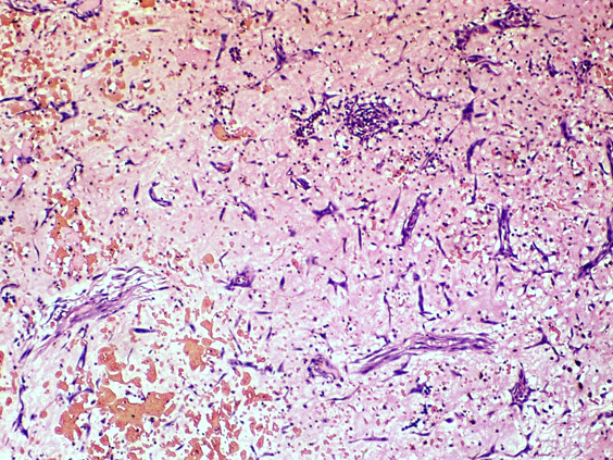 Tumor composed of stellate myxoma cells (Scanner)