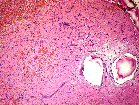 Tumor cells scattered in groups and in cystic spaces (Scanner)