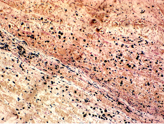 Perls stain showing hemosiderin deposition