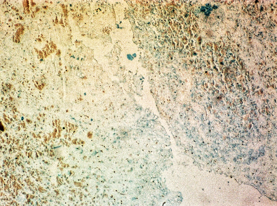 Alcian blue stain at pH 2.5 showing presence of bluish-colored acidic mucin in myxoid areas