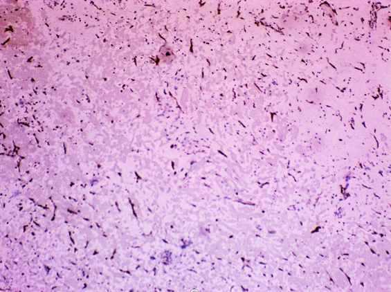 IHC Calretinin showing positive stain in stellate cells (LP)