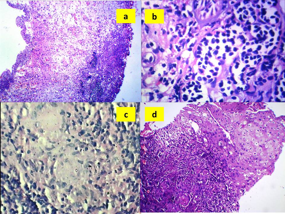 Histopathological Correlation of Cystoscopic Urinary Bladder Biopsies