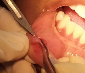 Excision of lesion with 10 blade