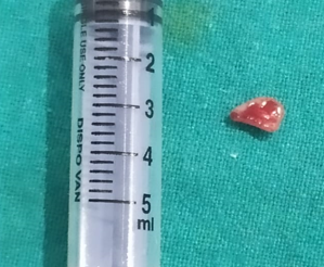 Tissue excised and was sent for