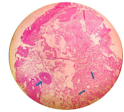 H & E section at 4X shows mucin pooled areas and salivary gland acini