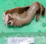 Gross showed an intact imperforated thick membrane 1.5 cm from distal resected margin