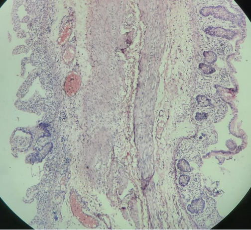 Section from the membrane showed,submucosa showed congestion and mononuclear cell infiltration.