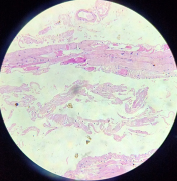 The microscopic picture of muscle biopsy with H and E staining showing atrophic muscle fibres with pink coloured accumulation of extracellular amorphous material, which was confirmed as Amyloid with Thioflavin stain.