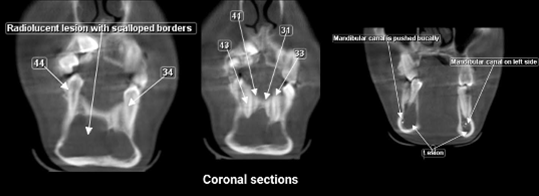 CT scan coronal section, radiolucent with scalloped border