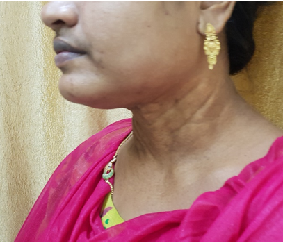 Lateral extension of cutis laxa.