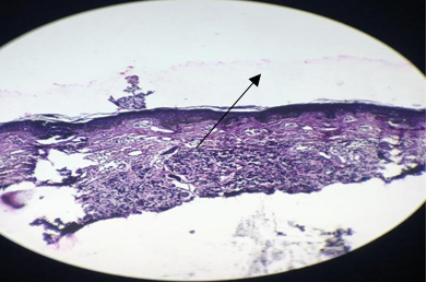 Abnormal elastic fibres (black) in the upper dermis showing transepidermal elimination of elastic fibres.