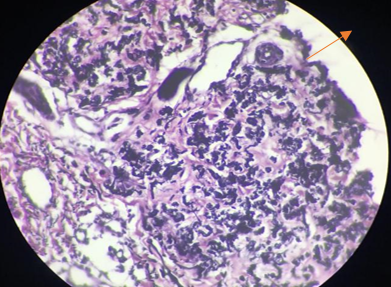 Abnormal elastic fibres in upper dermis and peri adnexal structures.
