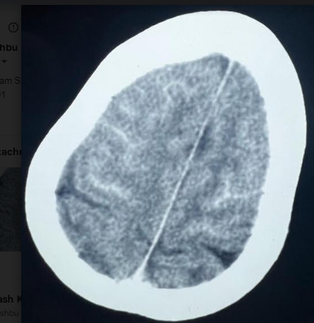 Axial CT head showing bilateral frontal sulcal hyper density mimicking subarachnoid hemorrhage.