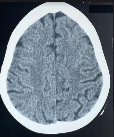 Normal CT head, taken 48 hours after the ictus.