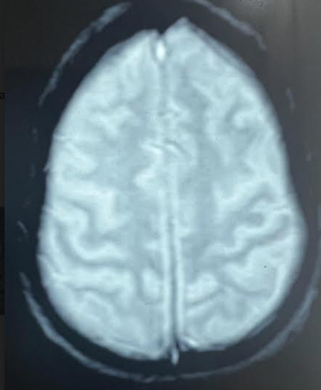 Normal MRI brain susceptibility weighted image, taken 72 hours after the ictus.