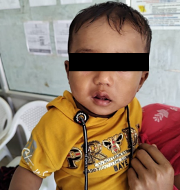 Dennie- Morgan folds and Pityriasis alba noted in an atopic child.