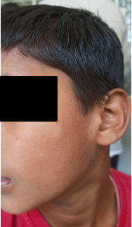 An atopic child, with rhinitis, generalized dry skin [xerosis] and Dennie-Morgan fold