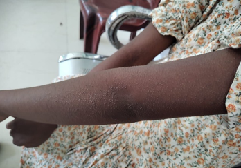 Keratosis pilaris in an atopic child