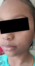 Pityriasis alba and xerosis in an atopic child.