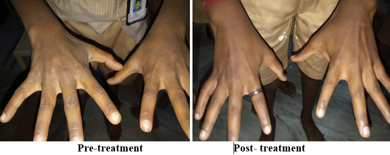 Group A- patient treated with topical permethrin
