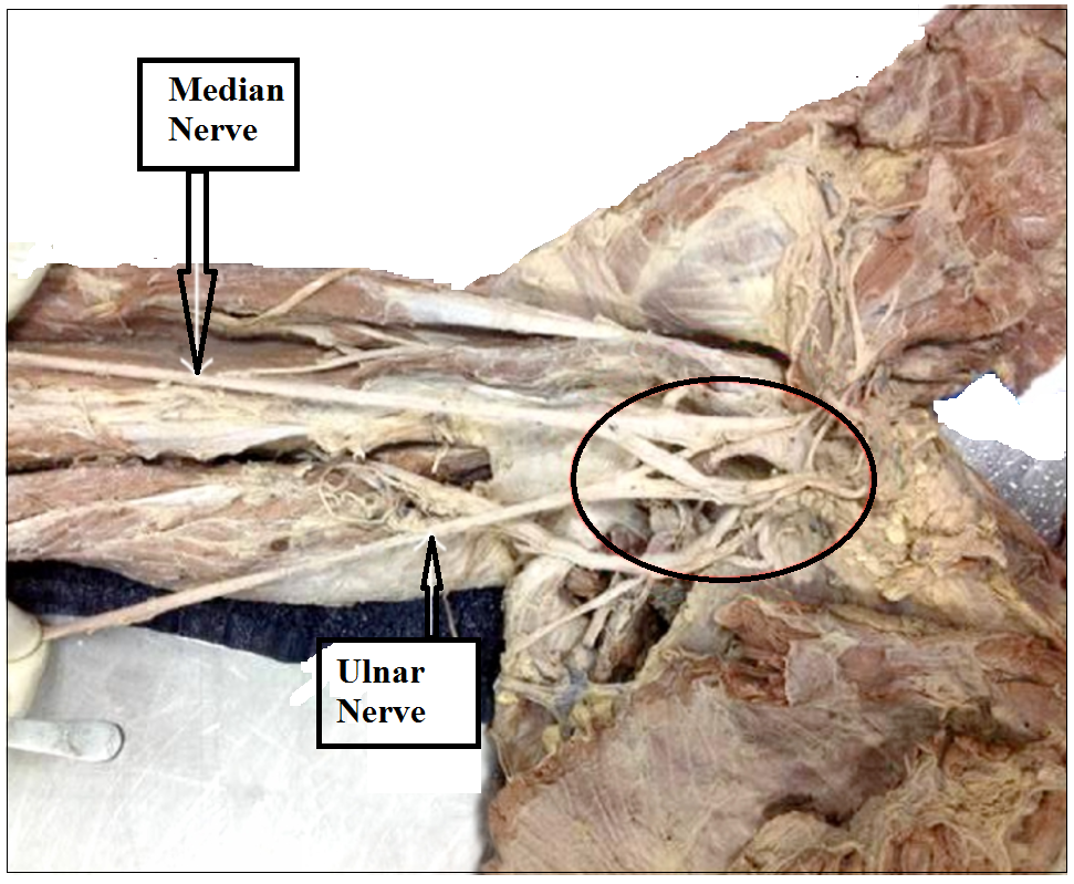 Aberrant formation of UN by the contribution of lateral and medial cords of brachial plexus