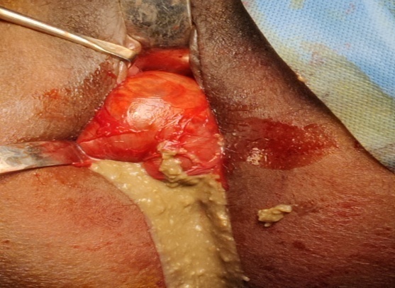 Cyst with thick brownish yellow discharge