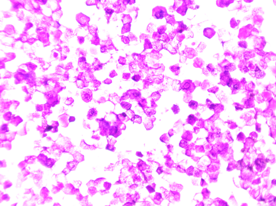 Giemsa stained FNAC Smears showing anucleate squames, cytomorphologically suggestive of epidermal cyst