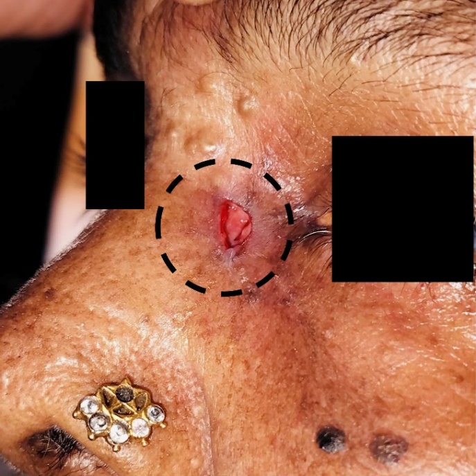 Ulcer near the medial canthus of the left eye with punched-out margins, pale granulation tissue, and exposed lacrimal sac.