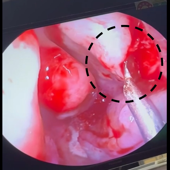 Elevation of the mucosal flap anterior to the middle turbinate using a Rosen circular knife, revealing the lacrimal bone and frontal process of the maxilla.