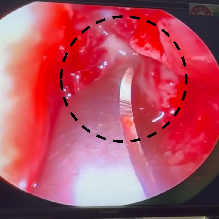 Vertical incision of the exposed lacrimal sac with a size 12 scalpel blade, creating an opening to the nasal cavity.