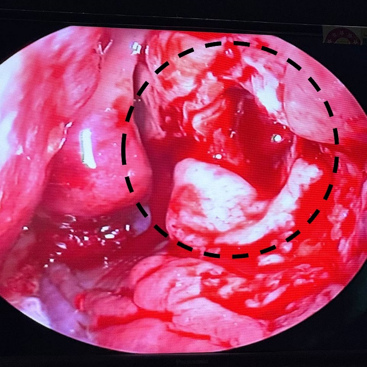 Obstruction site after clearance of pus, displaying open drainage pathways and improved visibility of underlying tissue.