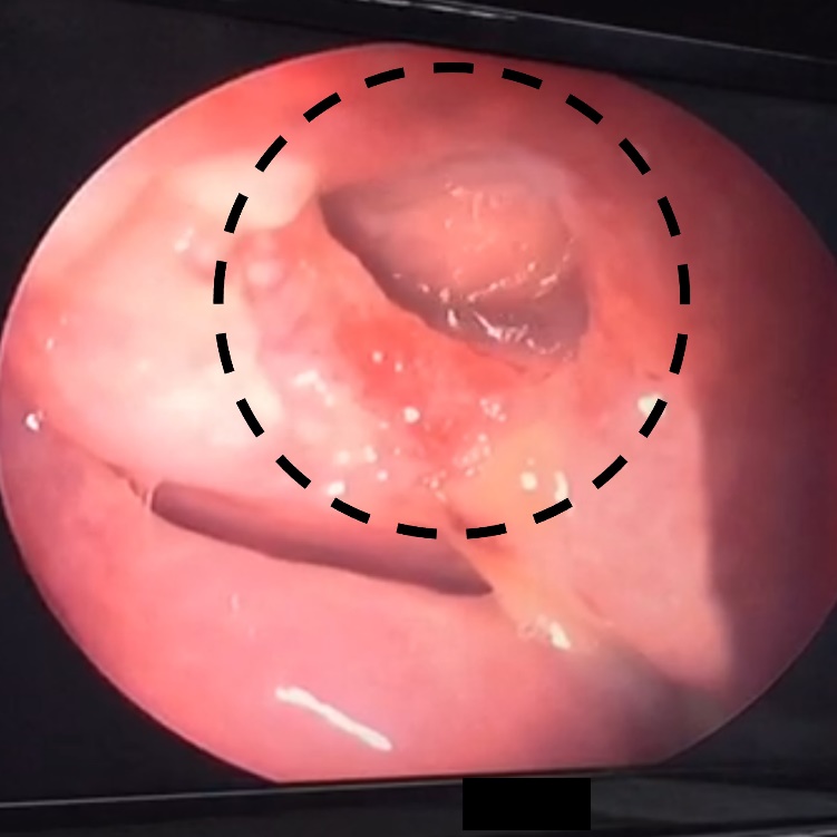 Endoscopic view after 2 months, showing a clear rhinostomy site with no signs of infection or blockage.
