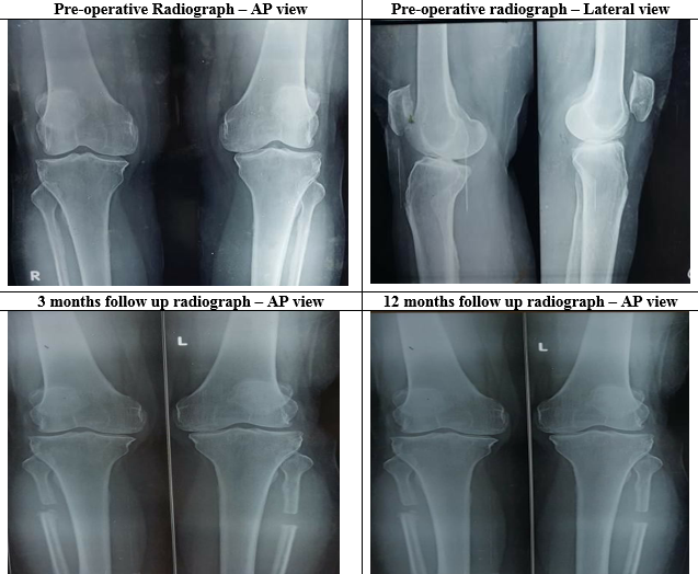 Pre and post-operative images of proximal femoral osteotomy in bilateral grade 2 osteoarthritis knees
