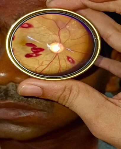 Shows color fundus photograph of a patient with chronic myeloid leukemia with retinal haemorrhage with central pallor area (Roth spots) in the retina 
