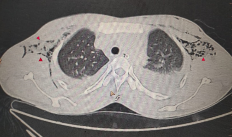 Magnetic resonance imaging scan of chest showing bilateral subcutaneous emphysema