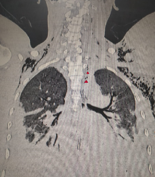 Magnetic resonance imaging scan of chest showing multiple air foci in mediastinum with suspicion of tracheal injury