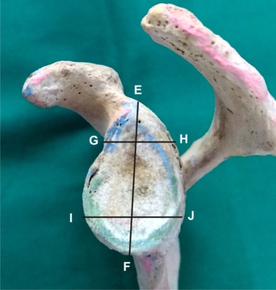 Showing measurments of glenoid cavity; E, F: height of glenoid cavity; I, J: Anteroposterior diameter1 of glenoid cavity; G, H: Anteroposterior diameter 2 of glenoid cavity