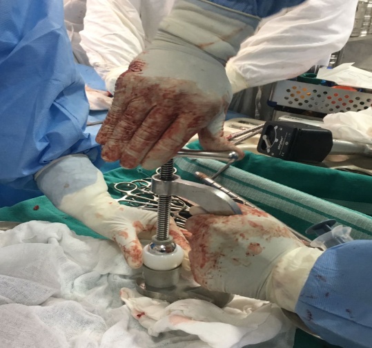 Assembly of femoral head