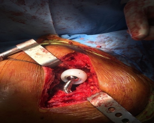 After implantation