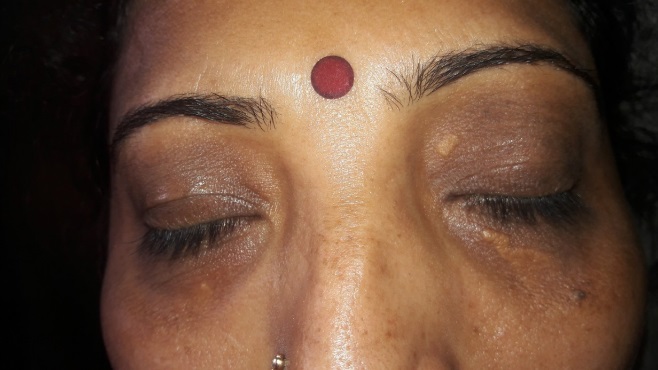 Unilateral left eyexanthelasma