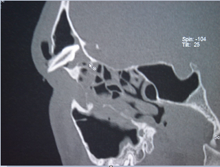 Computer tomography (CT) showing the displaced tooth into the frontal sinus.